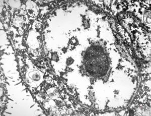 M, | cytomegalovirus - pneumonia M, | cytomegalovirus - pneumonia